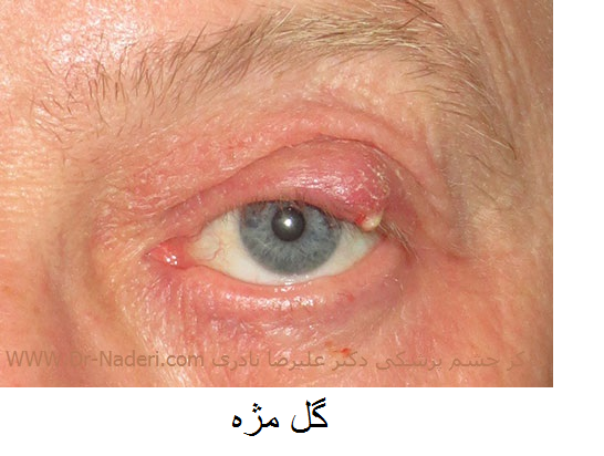 و پلک eyelid swelling